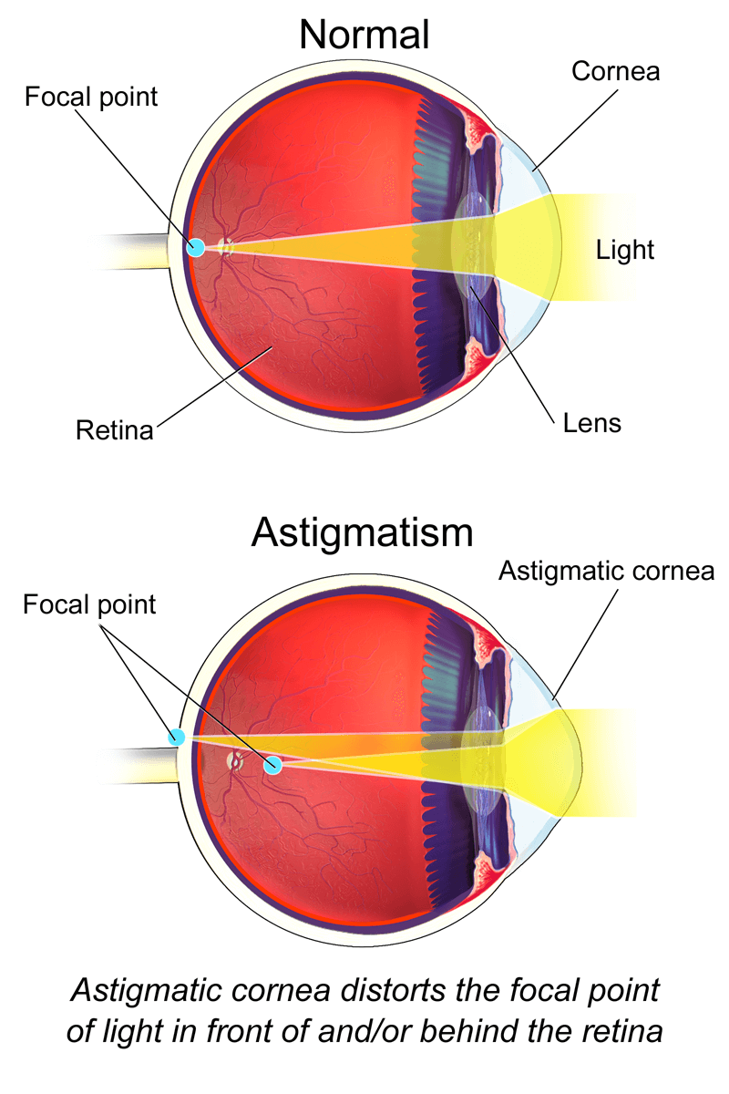 Astigmatism