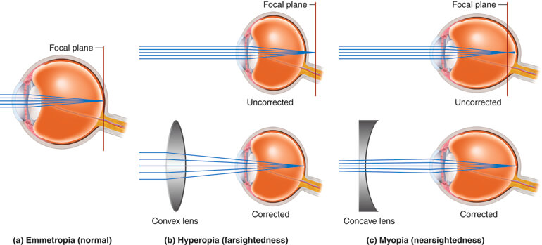 Myopia and Hypermetropia